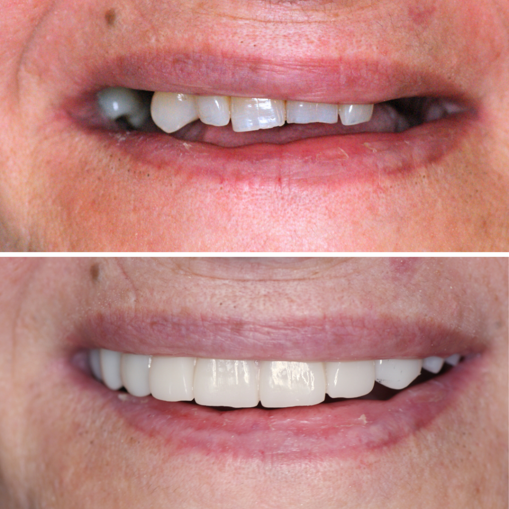 Denti fissi su impianti prima e dopo