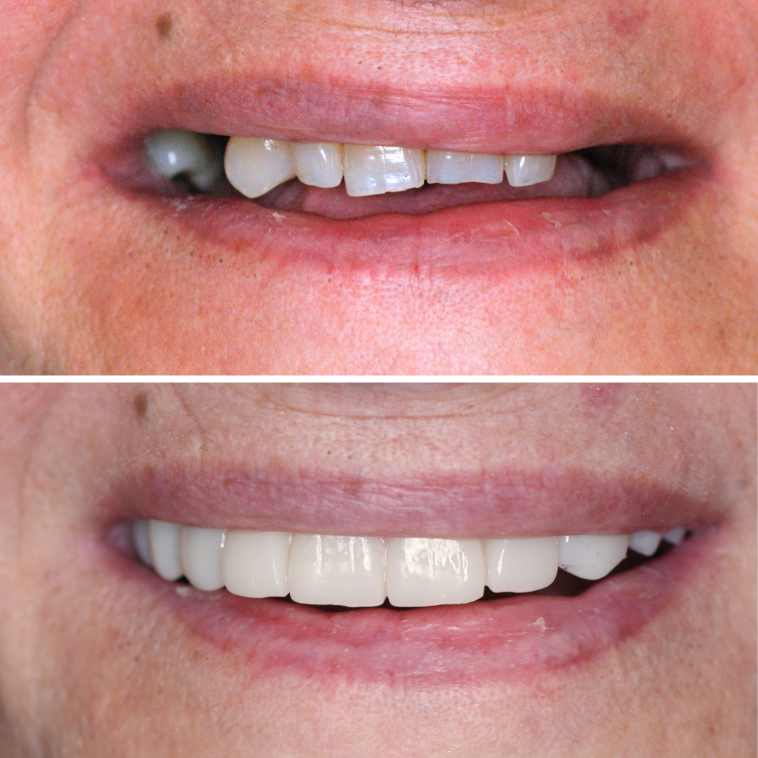 Denti fissi su impianti prima e dopo
