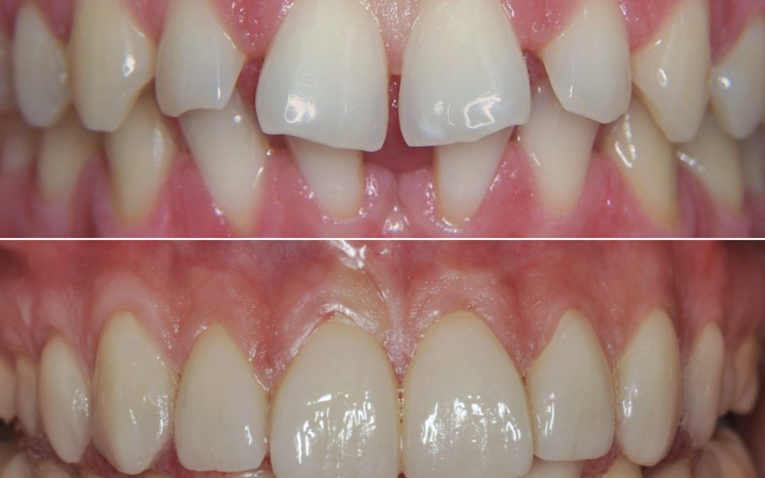 Faccette in ceramica integrale