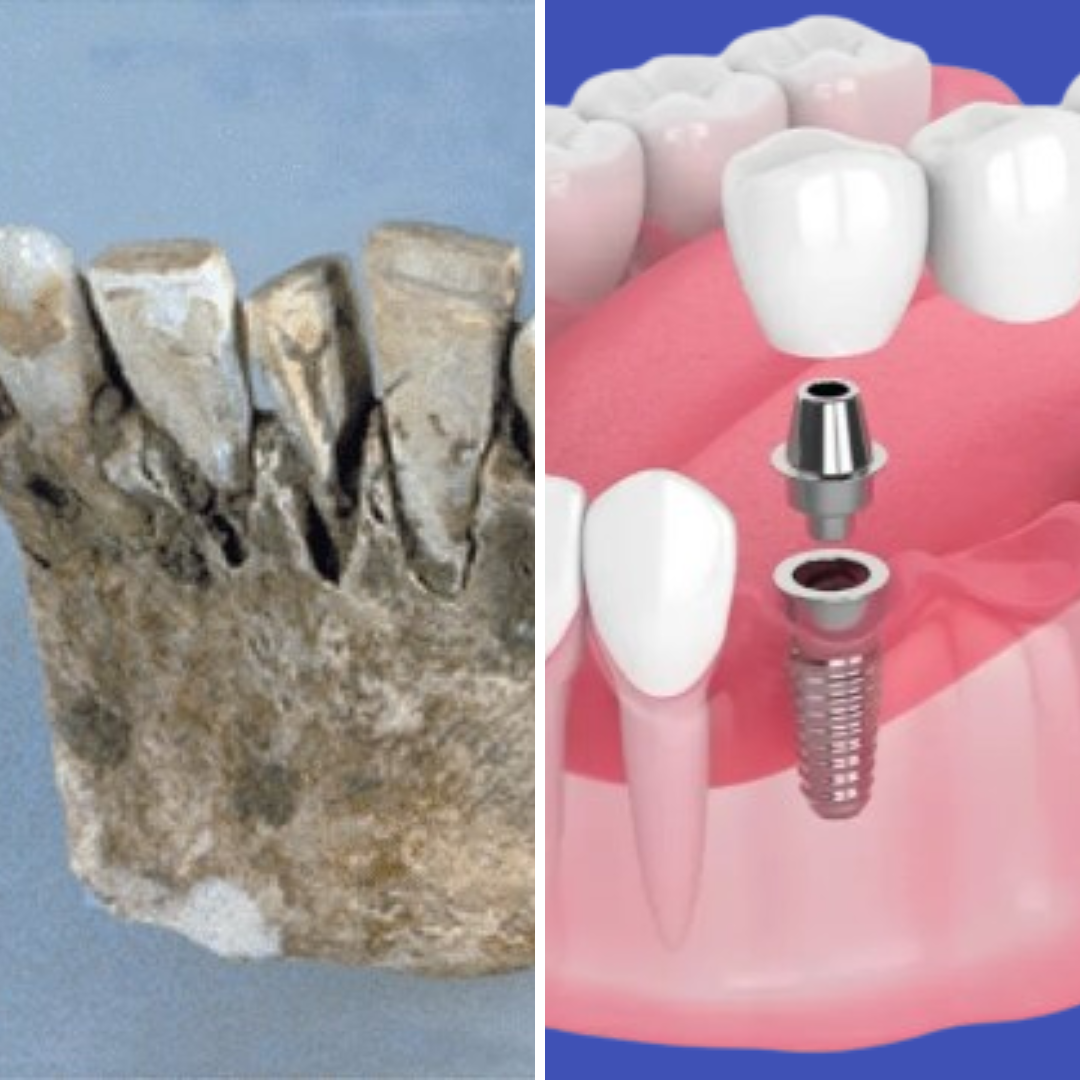 storia impianti impianti dentali antichi e impianti dentali moderni