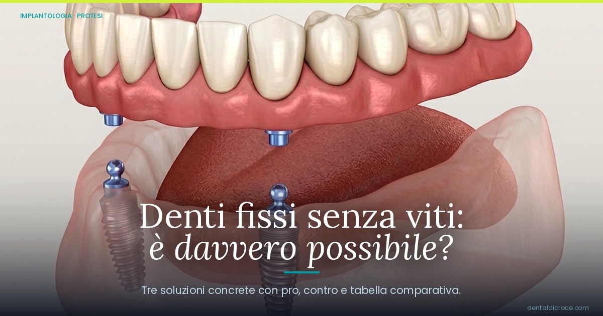 Modello dentale 3D con impianti che sostengono una protesi nell’arcata inferiore.