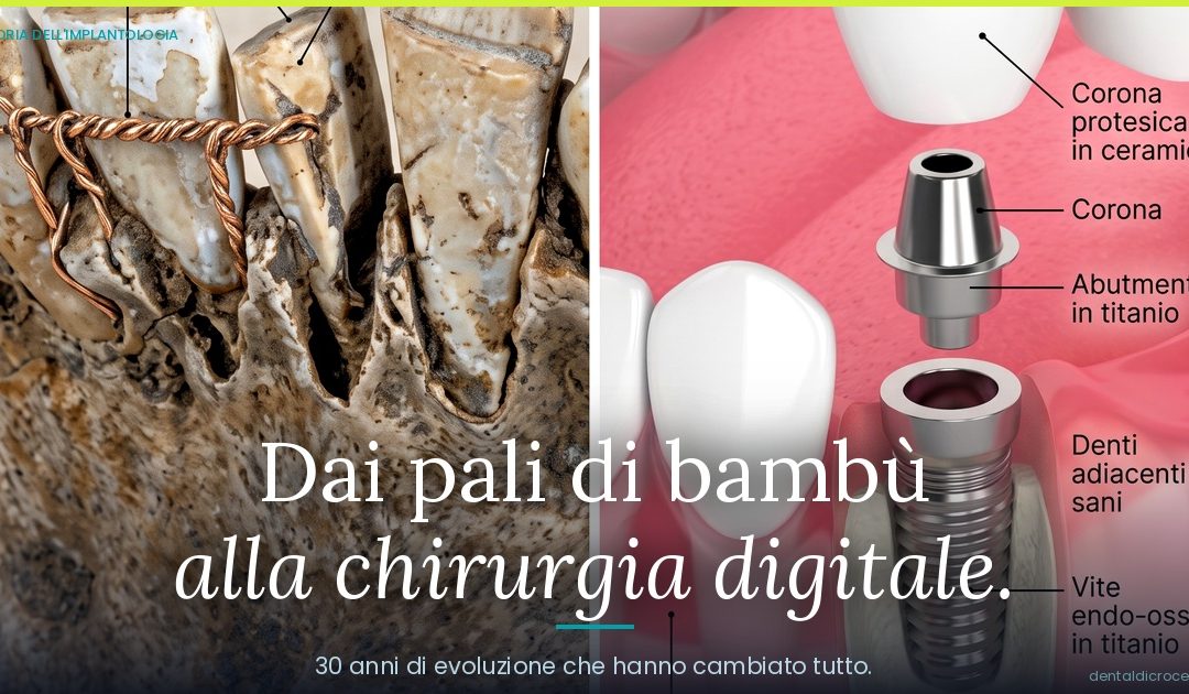 Storia dell’Implantologia Dentale: dai Pali di Bambù alla Chirurgia Digitale