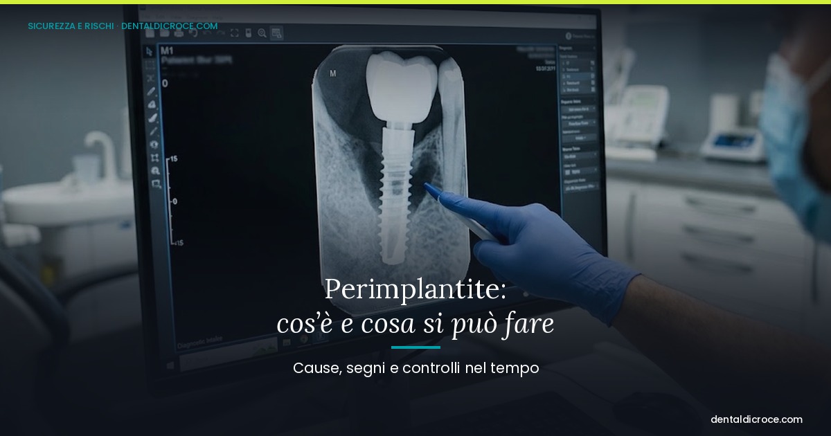 Dentist in blue glove points at a dental implant X-ray on a computer monitor; overlay discusses peri-implantitis (Italian title).